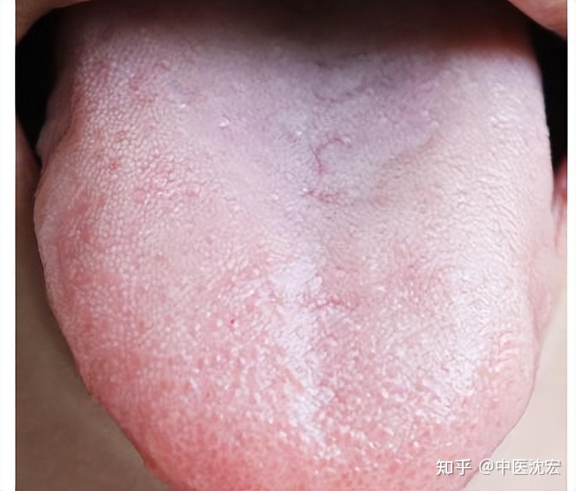 舌红有火,舌白缺血,舌胖气虚,身体好不好,看舌头就知道! - 知乎