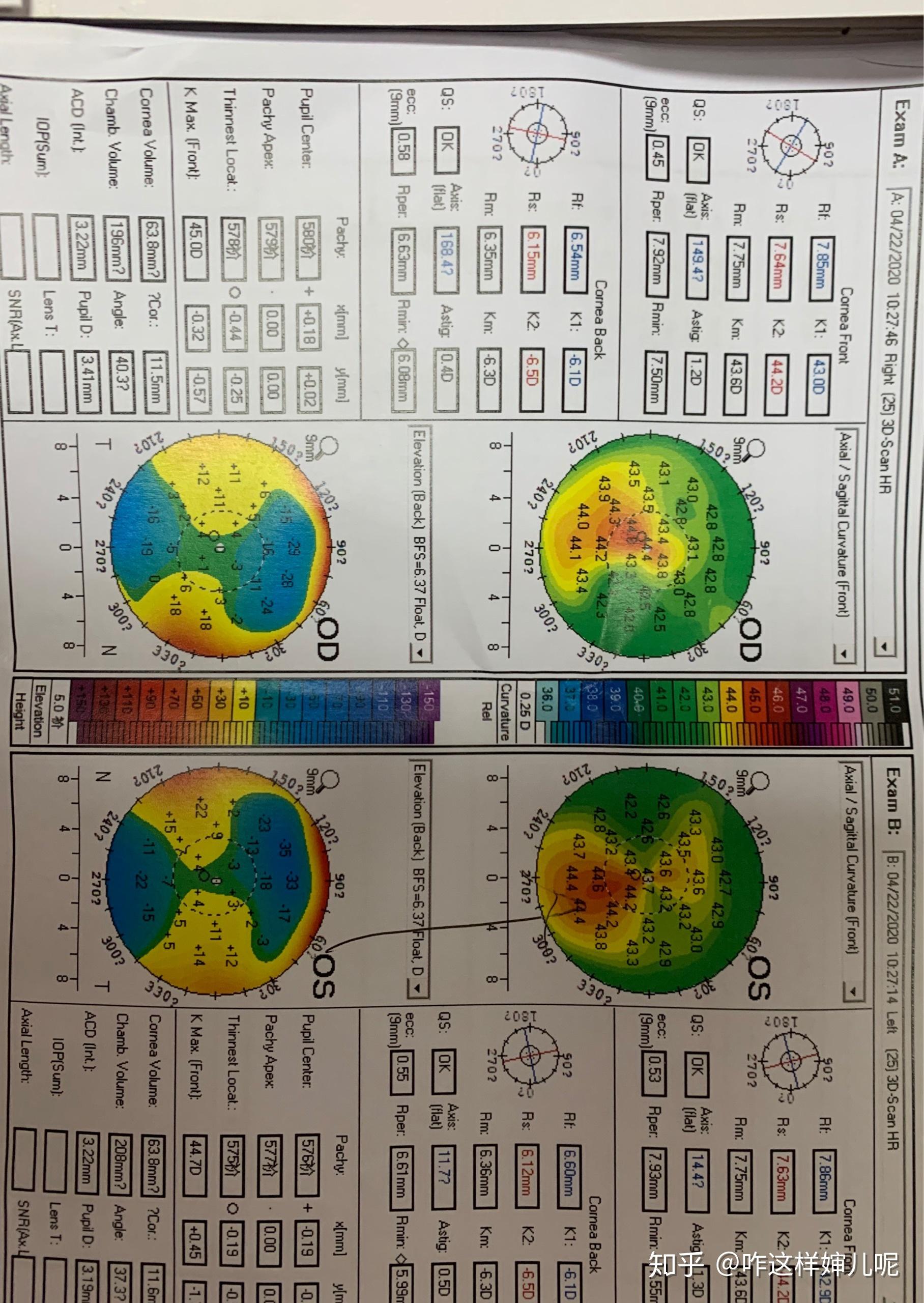 可以幫我看看角膜地形圖嗎,我怕圓錐角膜? - 知乎