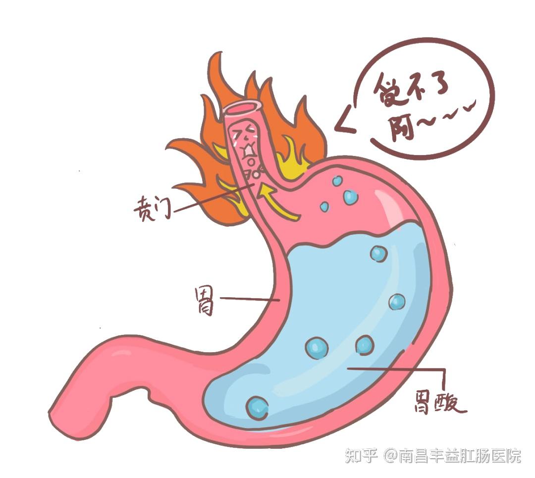 反酸、烧心，该如何解决？胃食管反流必须重视 - 知乎