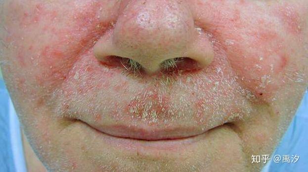 请问头部脂溢性皮炎产生的大块白色片状鳞片到底是什么物质以及诸多