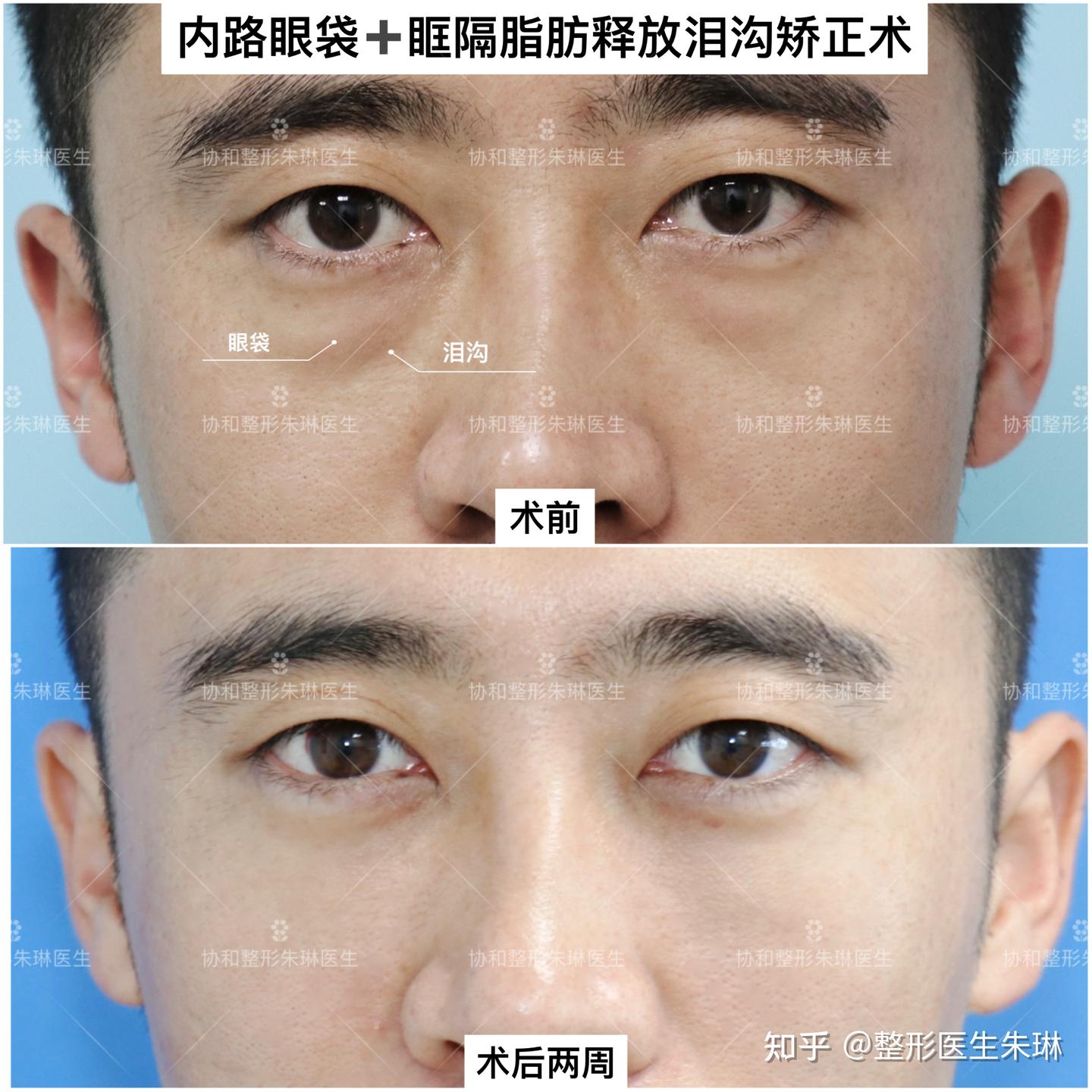 北京男士内路眼袋 眶隔脂肪释放泪沟矫正术，术后恢复一览 - 知乎