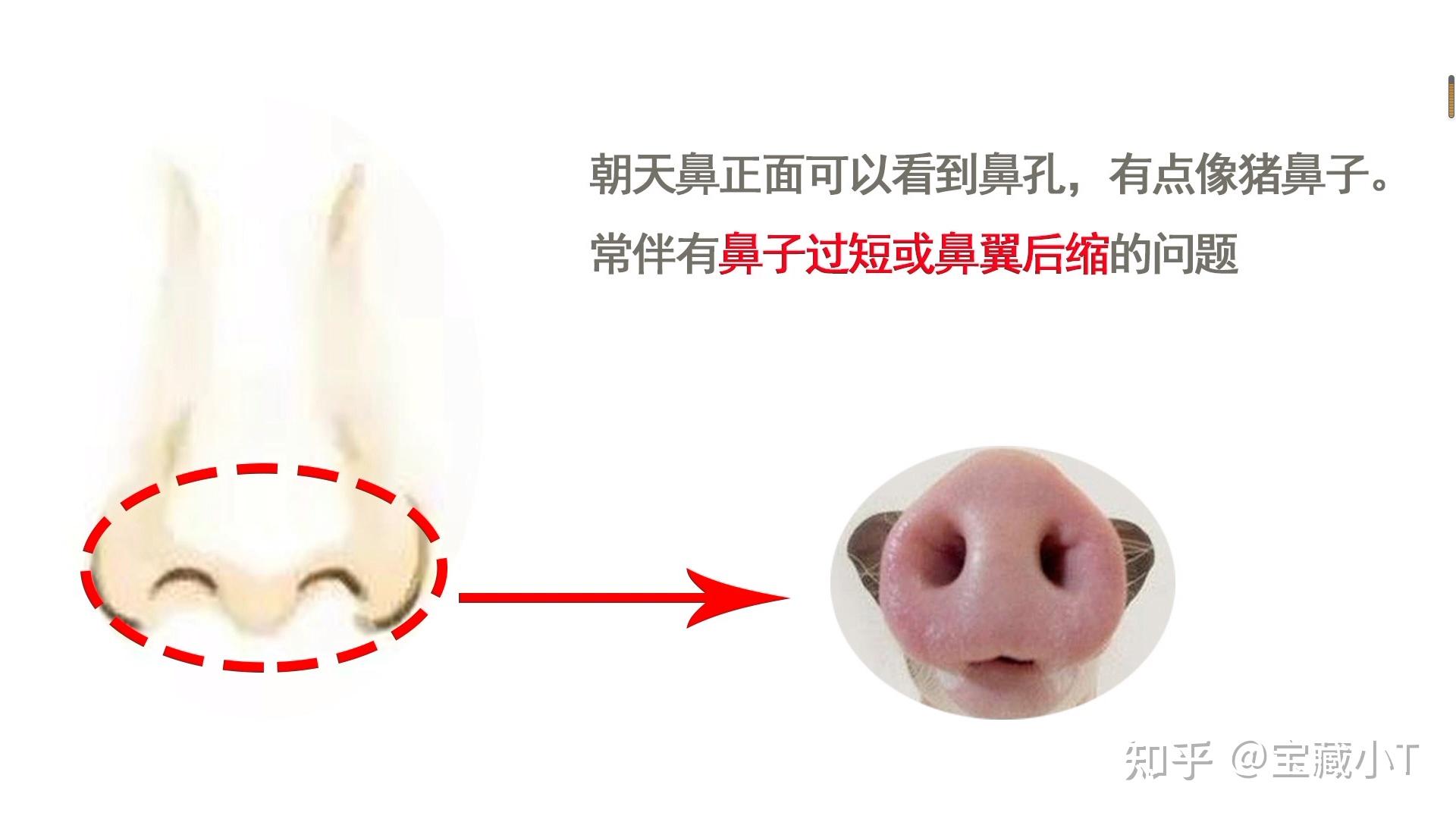 五大常见鼻型,你属于哪一种? - 知乎
