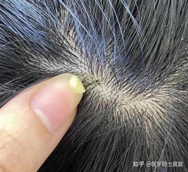 男生女生头皮屑大块大块地掉,密密麻麻像下雪一样,是不是没救了啊?【皮肤科医生】教你3步,1个月轻松摆脱大块头皮屑,头屑严重者赶紧点进来!