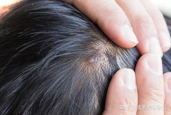 头皮脂溢性皮炎这么治,就不会走到脱发那一步 - 知乎