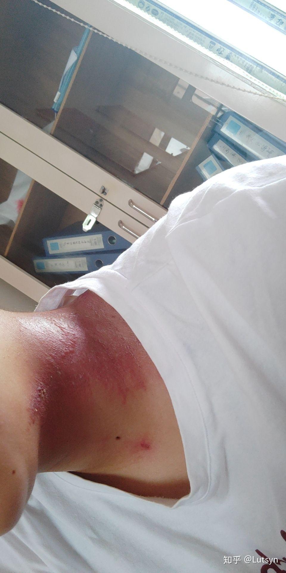 隐翅虫造成的伤口有什么特点?