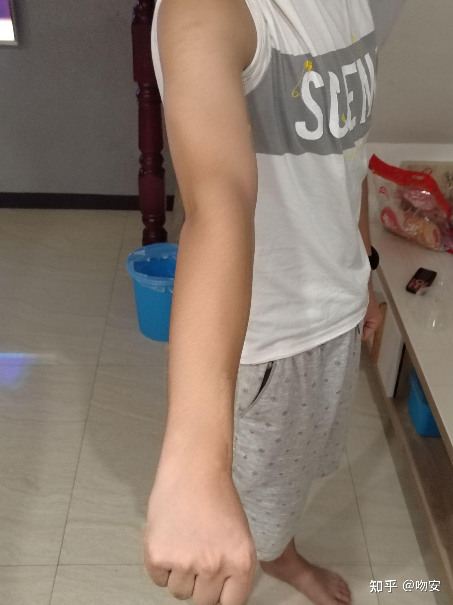 我想问一下我的这个算肘外翻吗?军检有没有问题?