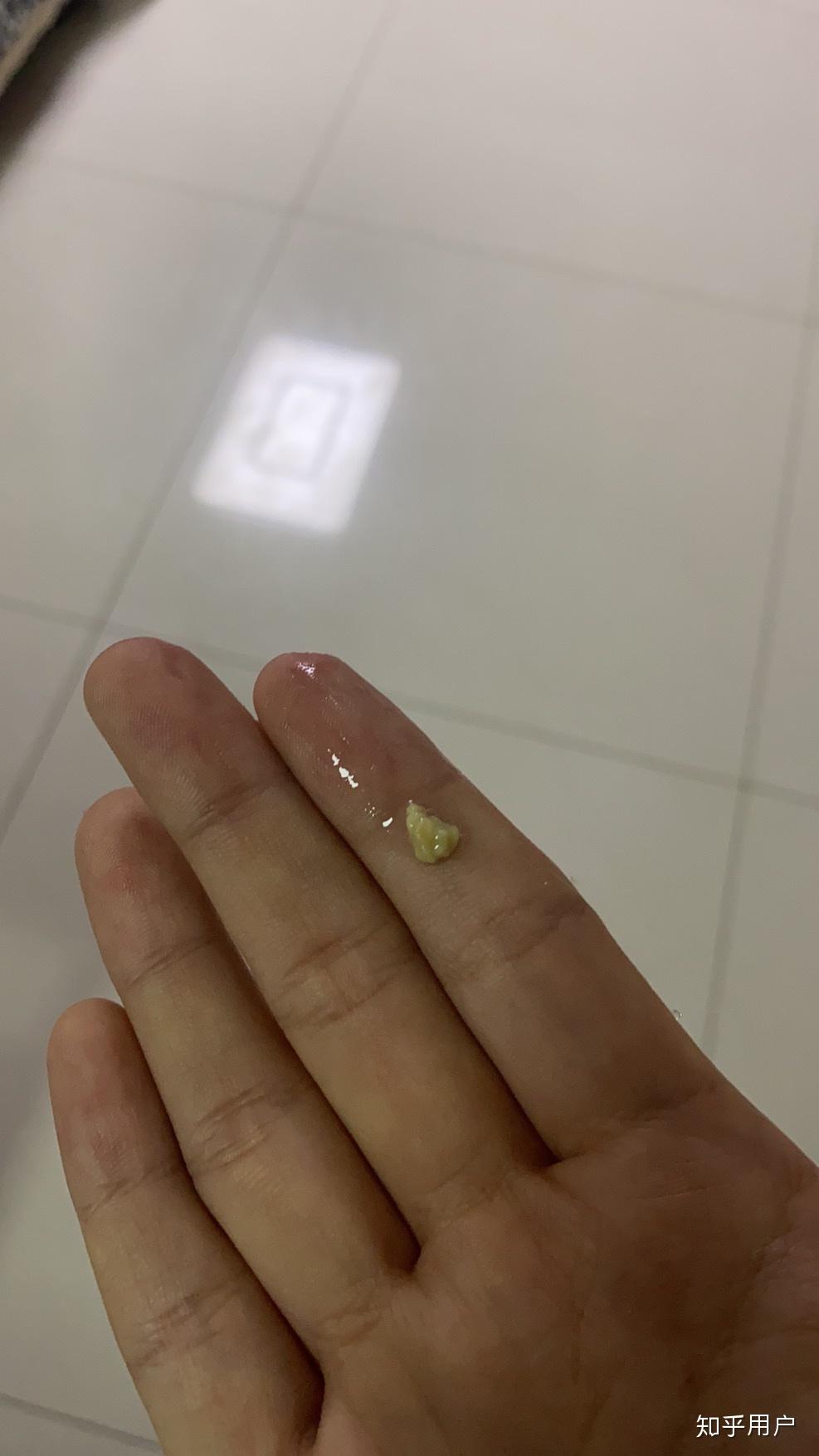 你见过最大的扁桃体结石有多大