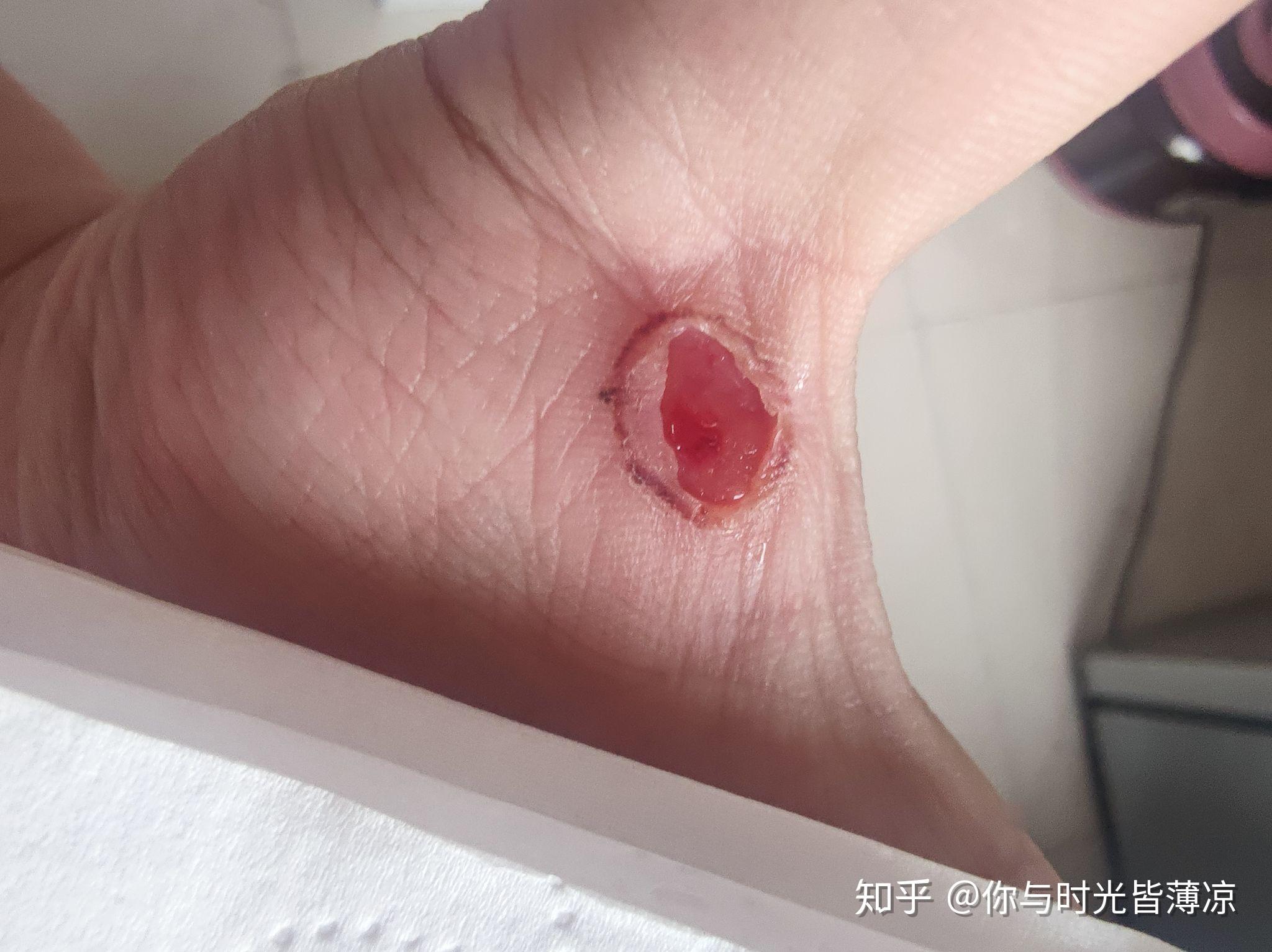 液氮冷冻治疗后手指上出了血泡而且越来越大该怎么办? - 知乎