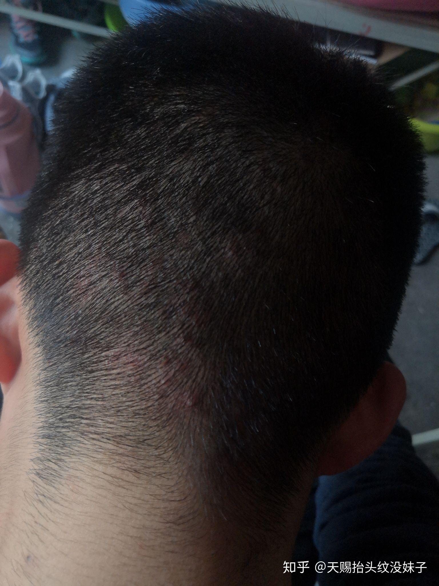 如何乐观的面对毛囊炎导致的头部多发囊肿