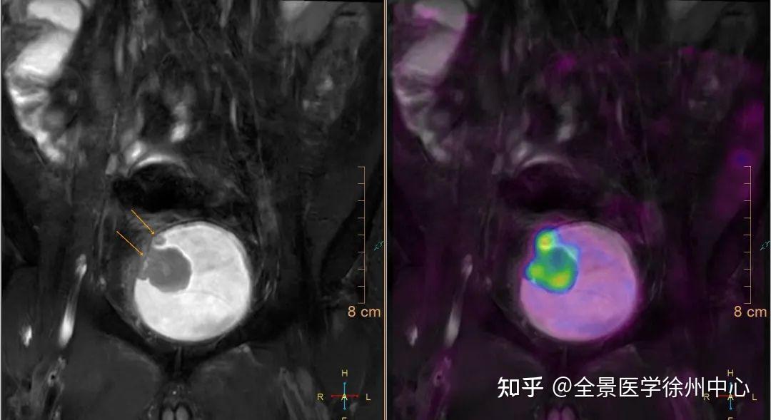 做了PET/CT为什么还要再做磁共振融合，会不会重复了？ - 知乎