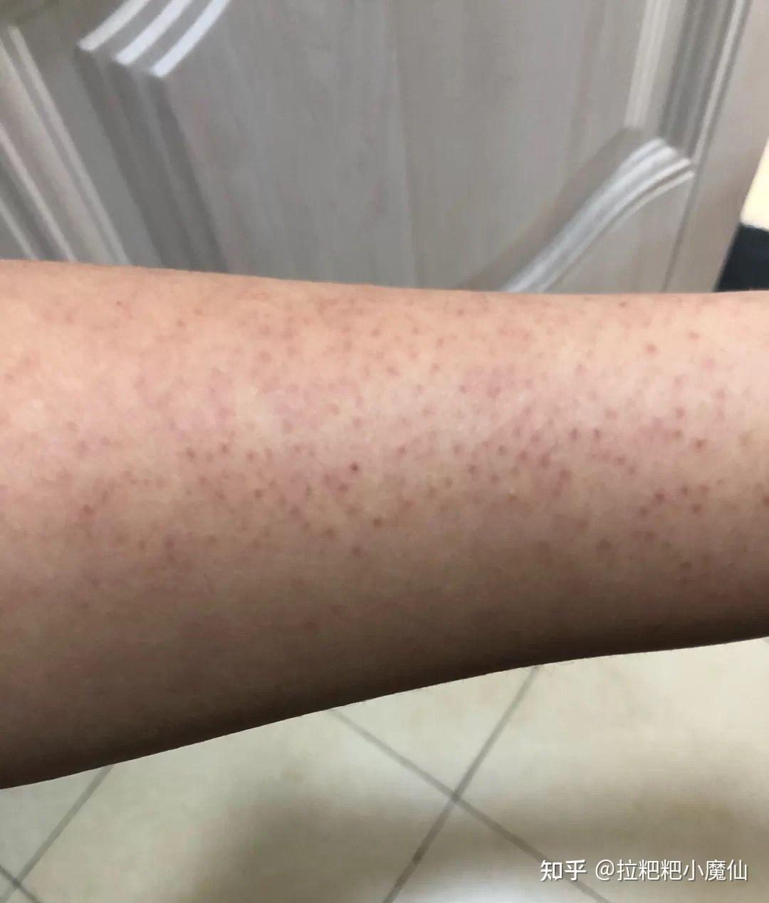腿上鸡皮肤变成红疙瘩怎么办(腿上鸡皮肤变成红疙瘩怎么办啊)