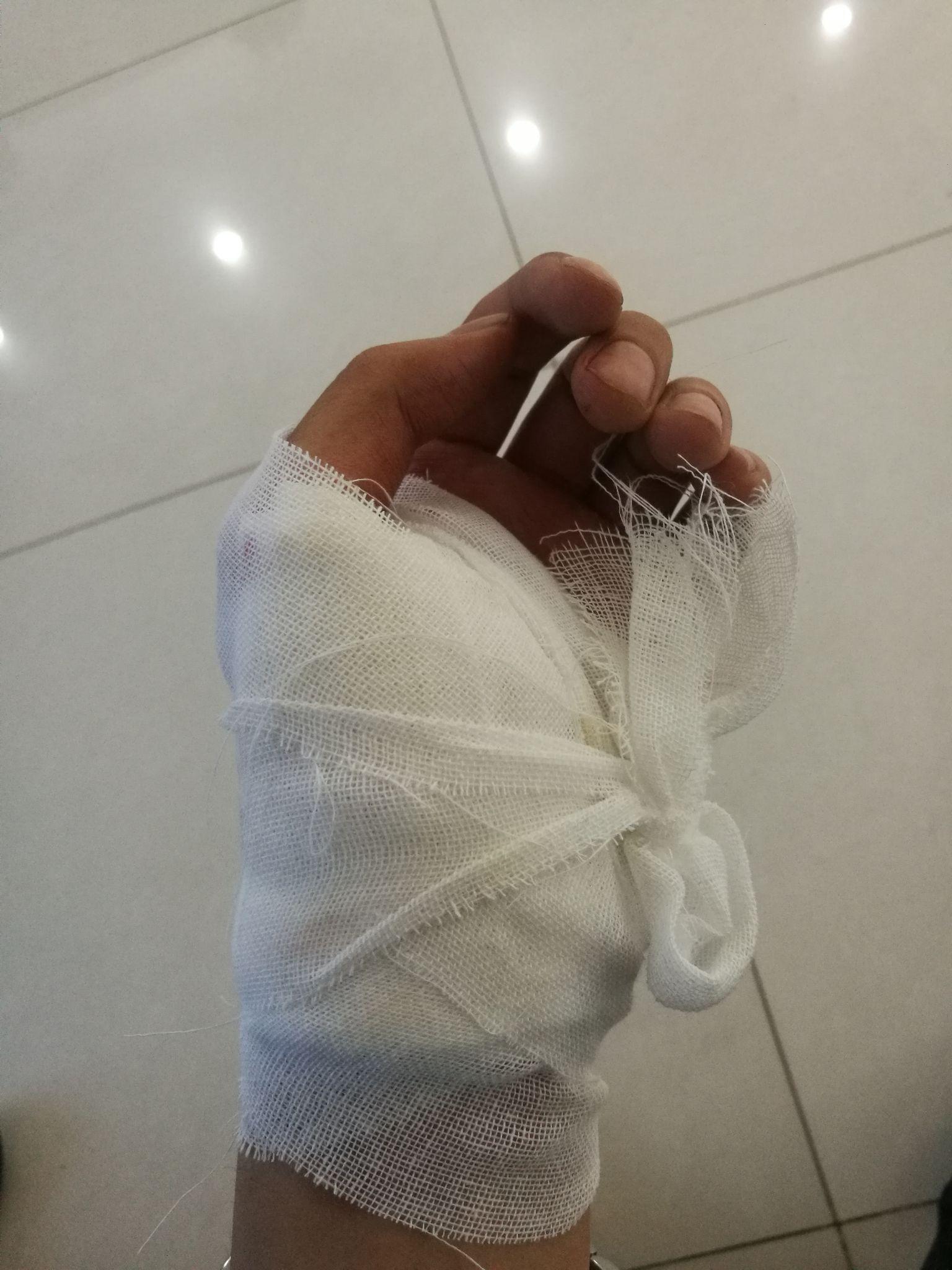 缝针和拆线可怕吗?疼吗?你们当时怕吗?