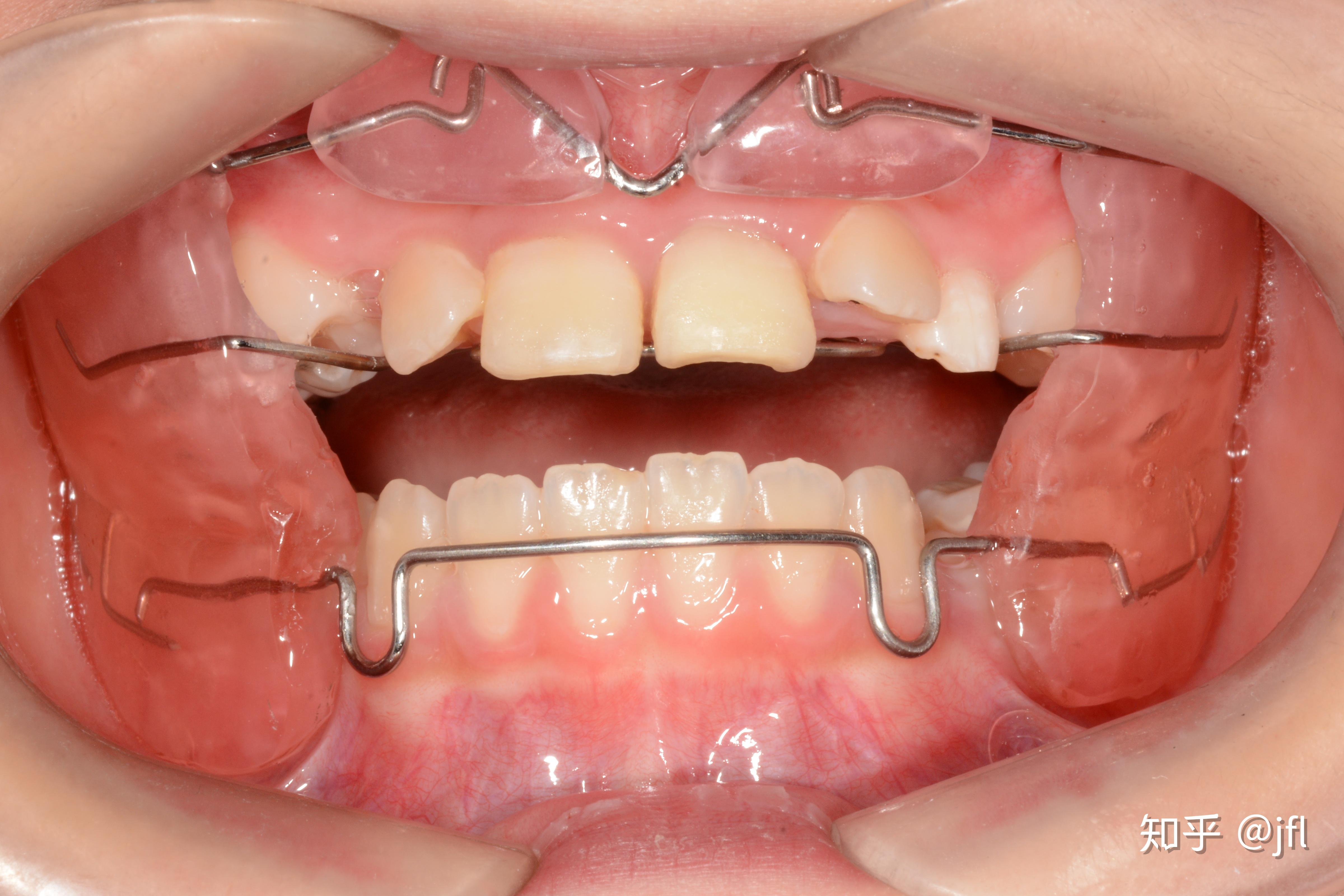 网上卖的隐形矫正牙套有没有用