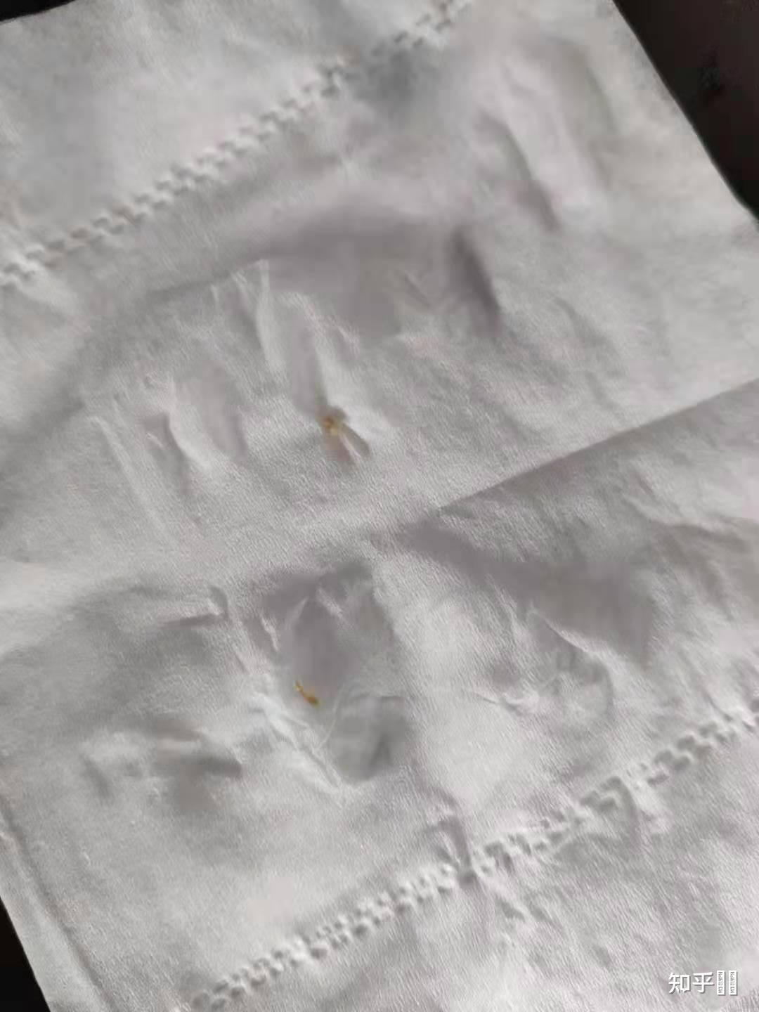 鱼刺会卡在喉咙两年多吗? - 知乎
