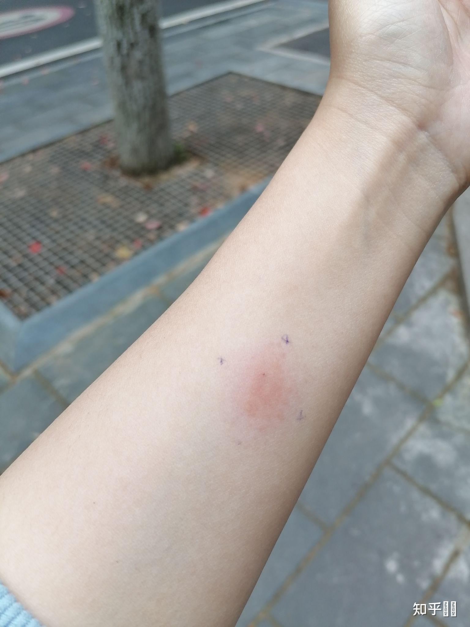 ppd皮试后这个样子怎么办