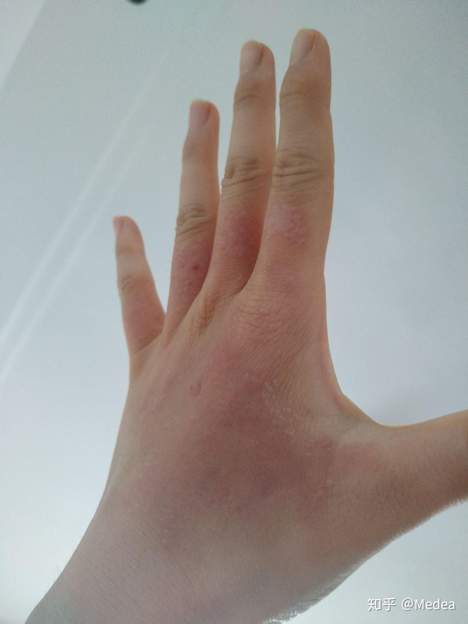 手被开水烫伤了怎么办? - 知乎