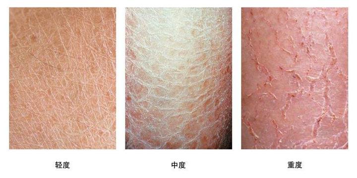 洗澡时间太久为什么容易引起乏脂性