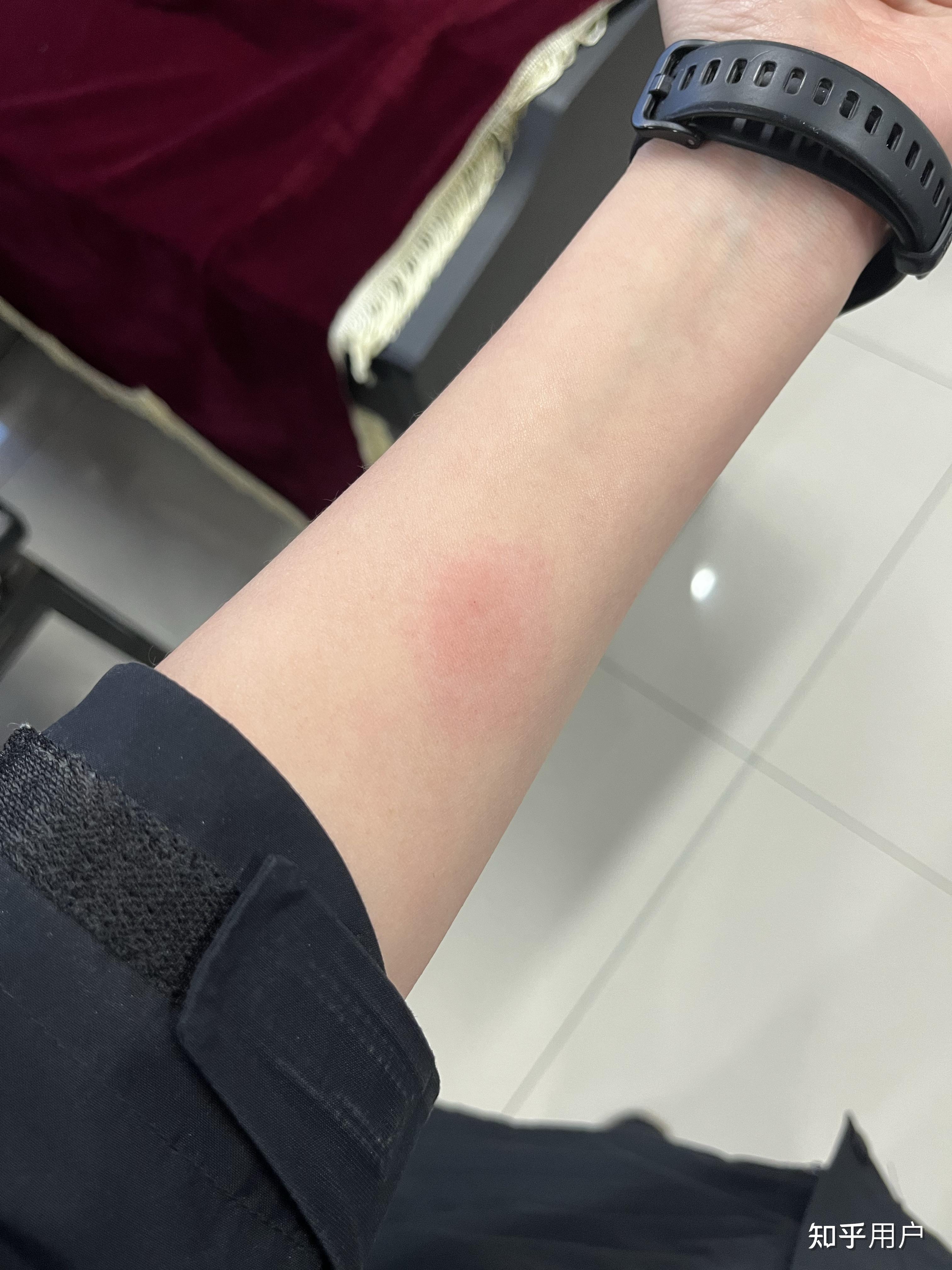 ppd皮试后这个样子怎么办? - 知乎