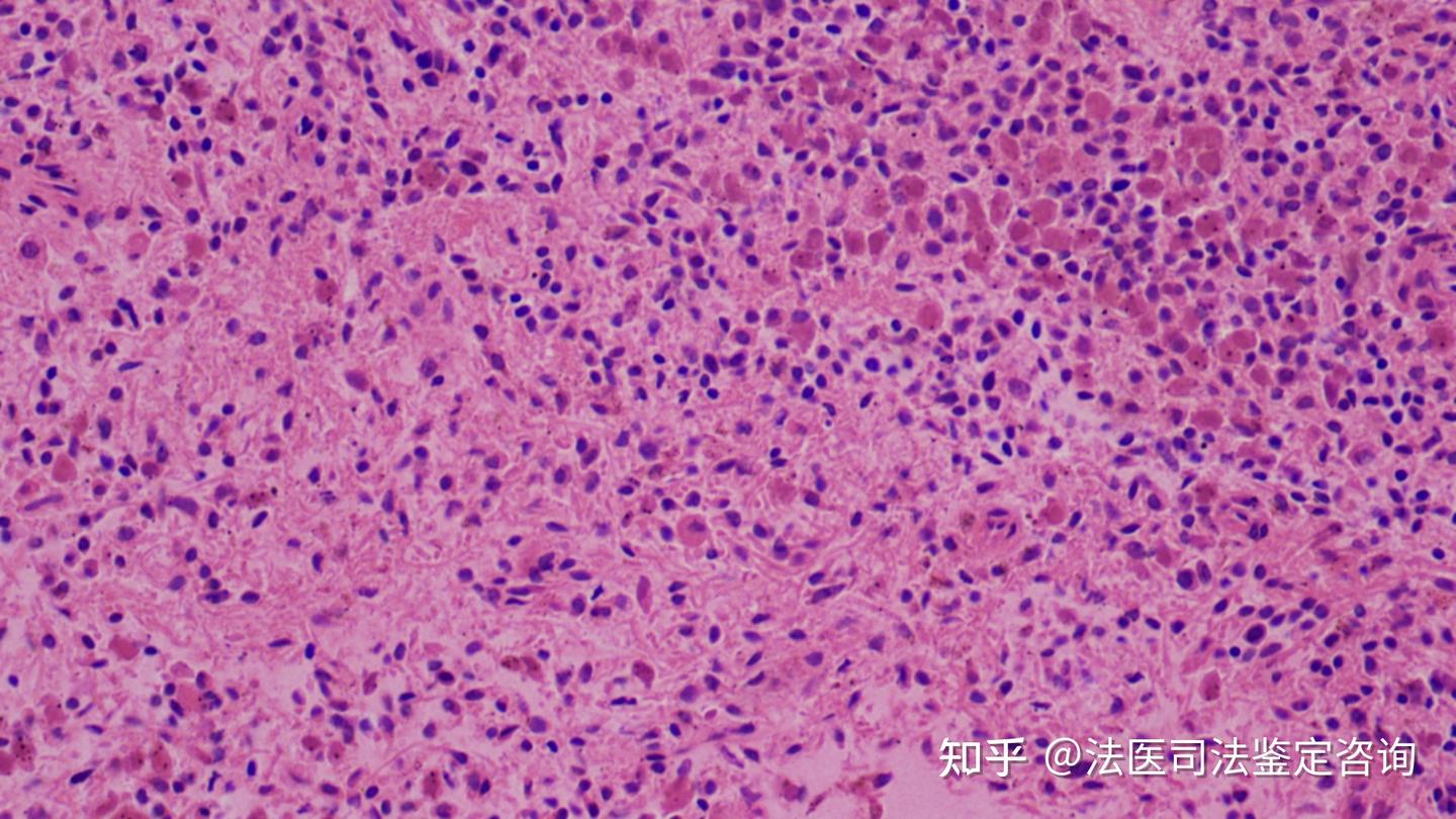 重症感染时脾脏的病理改变 - 知乎