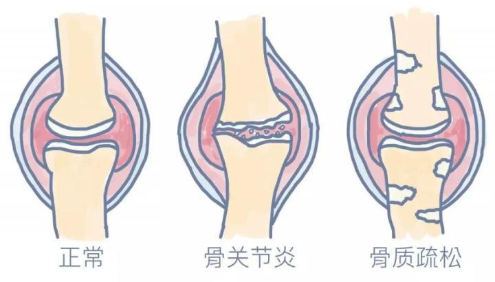 骨关节炎的自测如何科学有效的预防骨关节炎 知乎