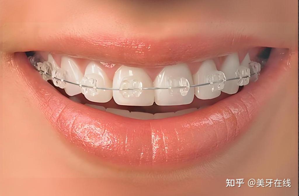 关注问题 67 写回答 登录/注册 牙齿矫正方法 矫正牙齿费用?