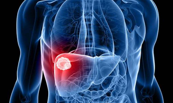 肝囊肿应该注意什么