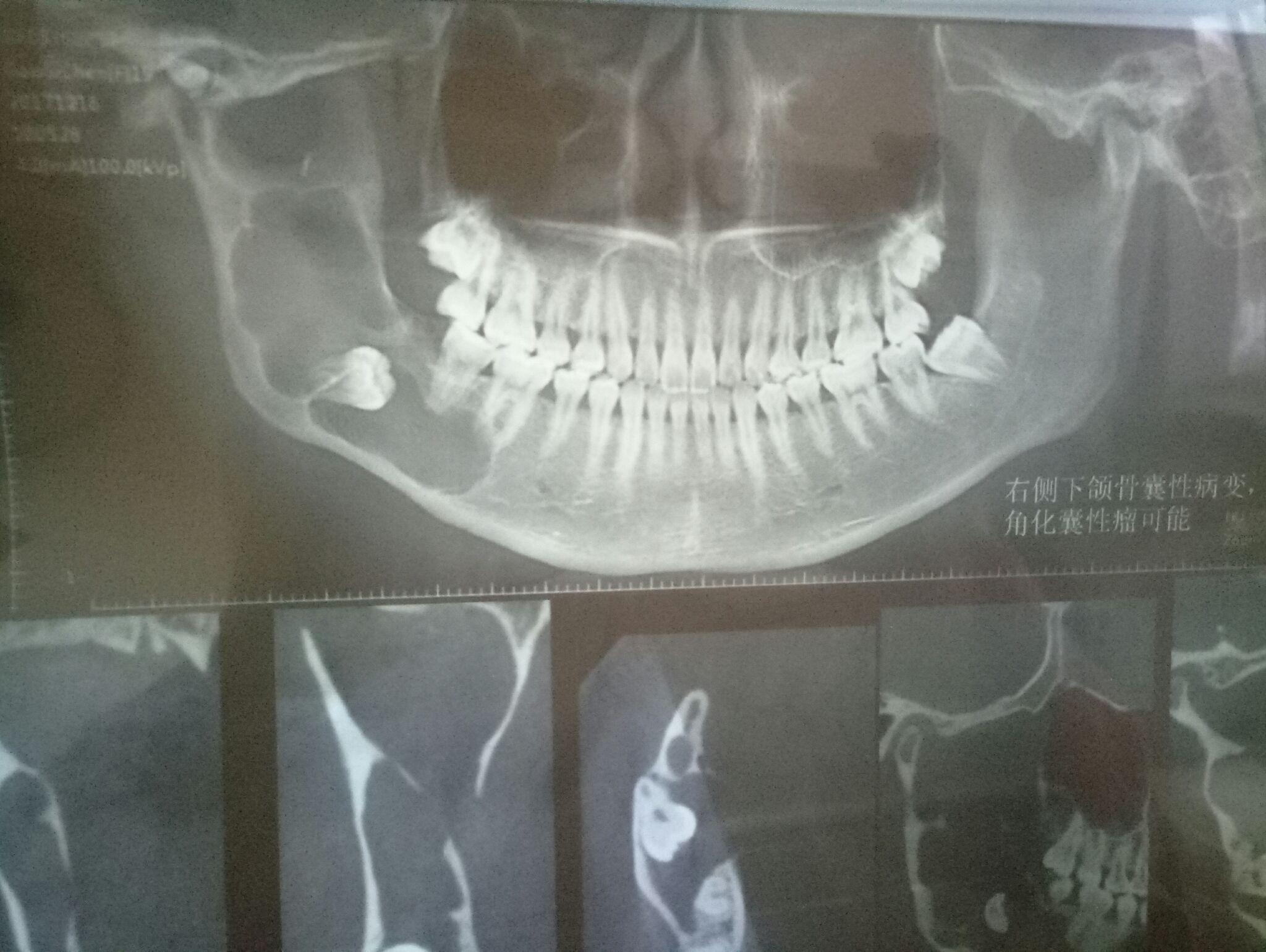 请问各大神,下颌骨囊肿如何治疗?做手术有风险吗? - 知乎