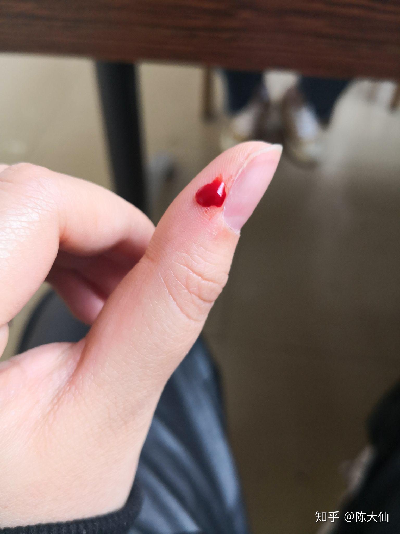 克制不住的抠手指头是心理问题吗? - 知乎