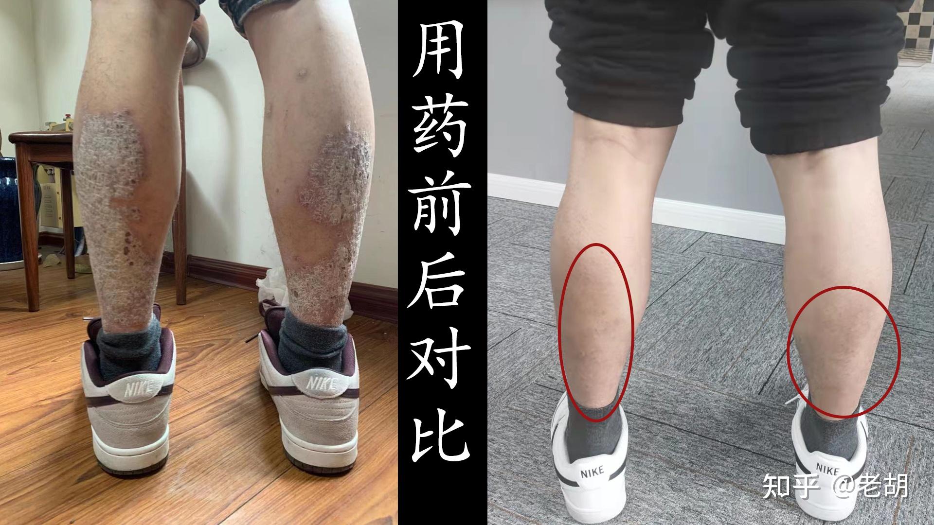 可善挺(苏金单抗)治疗银屑病的优势及其注射周期 - 知乎