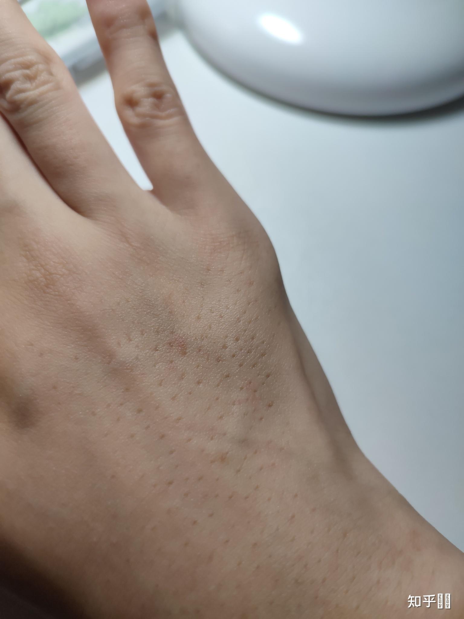我是女生,手背上汗毛很多,毛孔特别大,密密麻麻的,大家有紧毛孔的办法