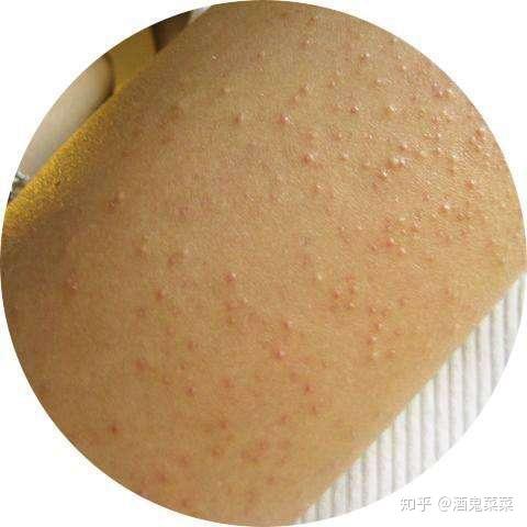 医美方式如何改善鸡皮肤(鸡皮肤可以通过医美去除吗)