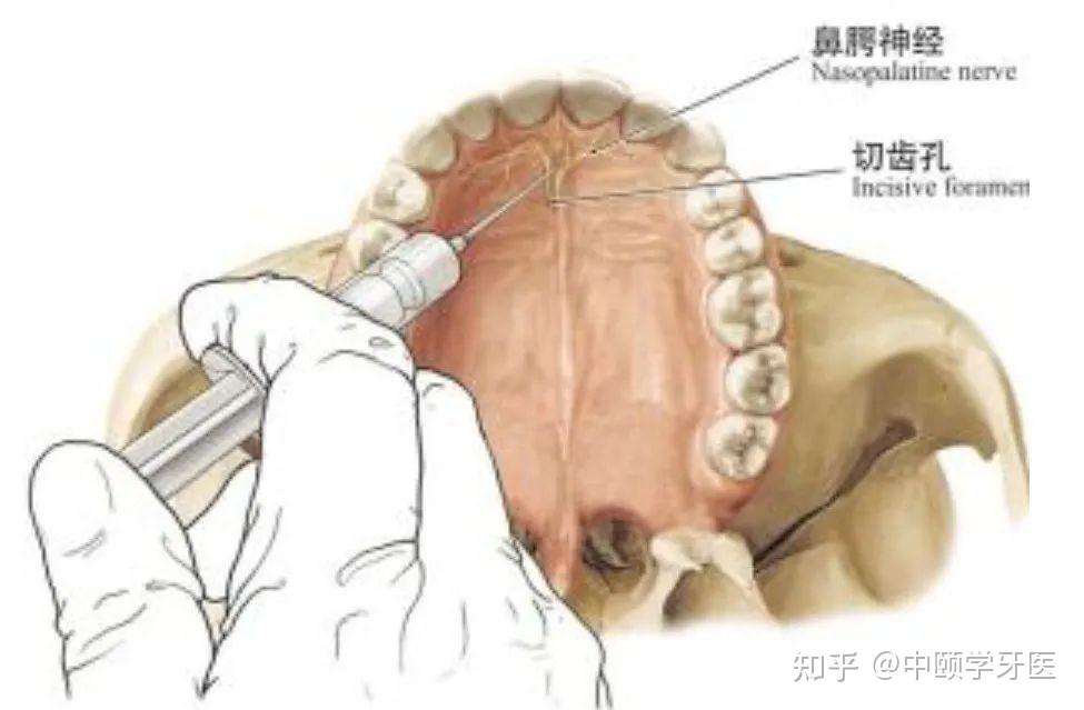 口腔局部阻滞麻醉方法：上颌神经及其分支阻滞麻醉 - 知乎