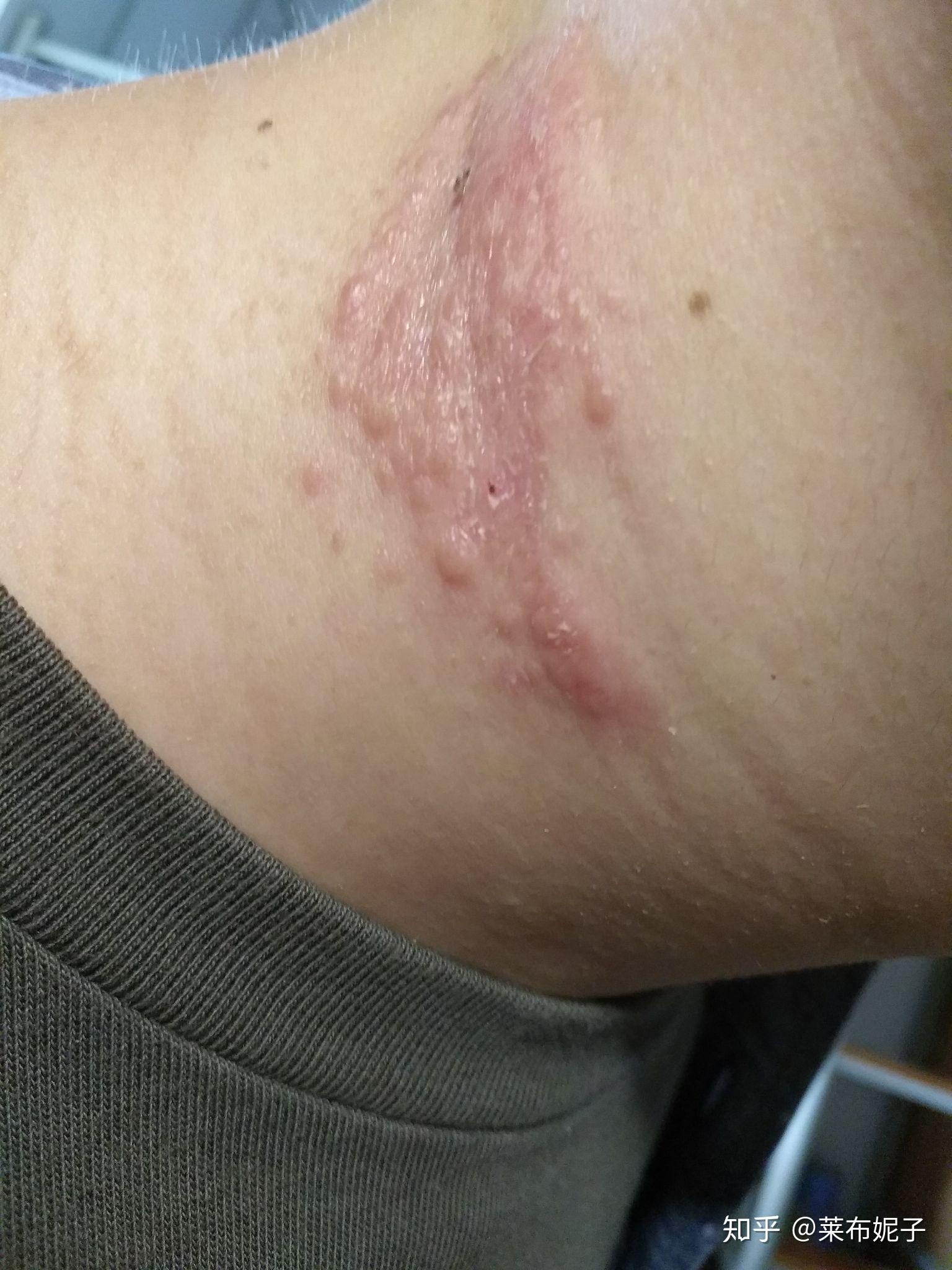 隐翅虫叮咬如何治疗