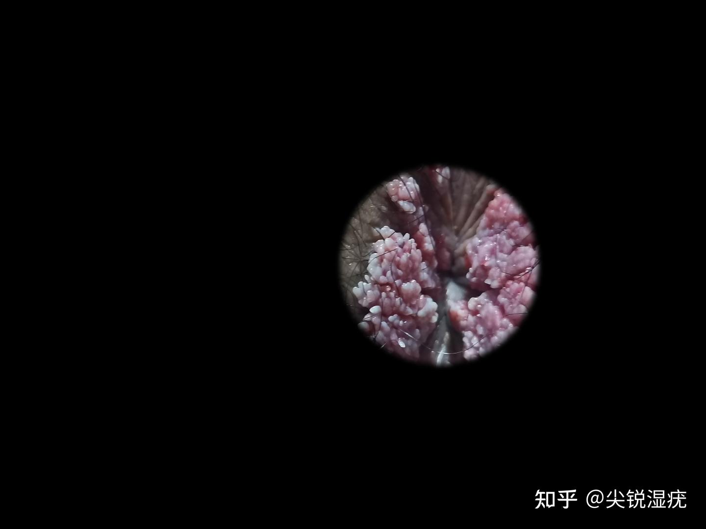 hpv低危11阳性有疣体 - 知乎