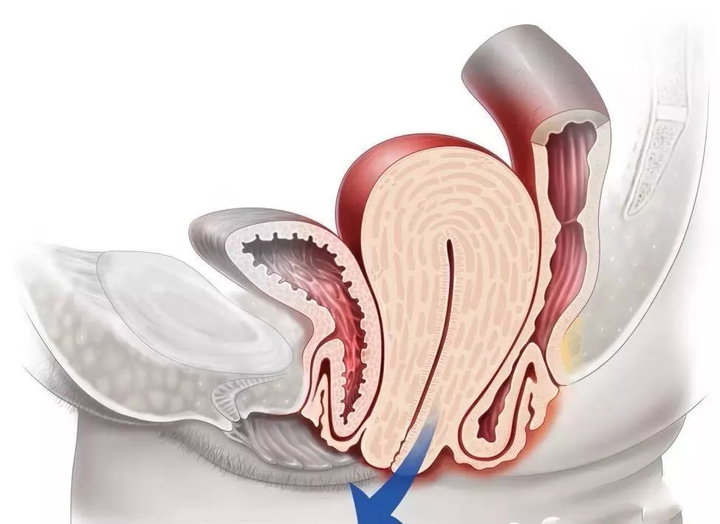 紧致的盆底肌是夫妻生活的关键也是防止内脏下垂的重要保障