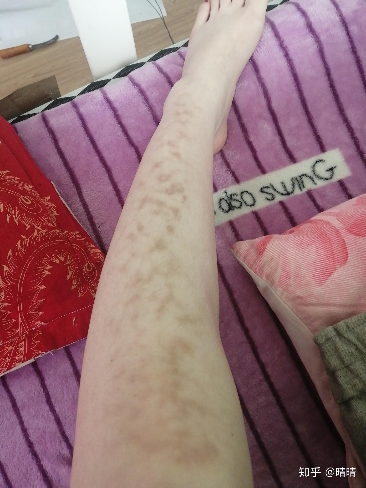 小太阳取暖器烤的时候离的太近,腿部大片皮肤出现蜘蛛网状的红斑,怎么