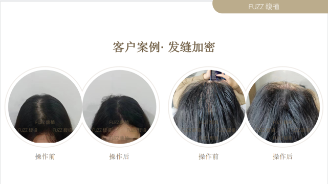 植发后有伤疤怎么修复?可以通过纹发来弥补 - 知乎