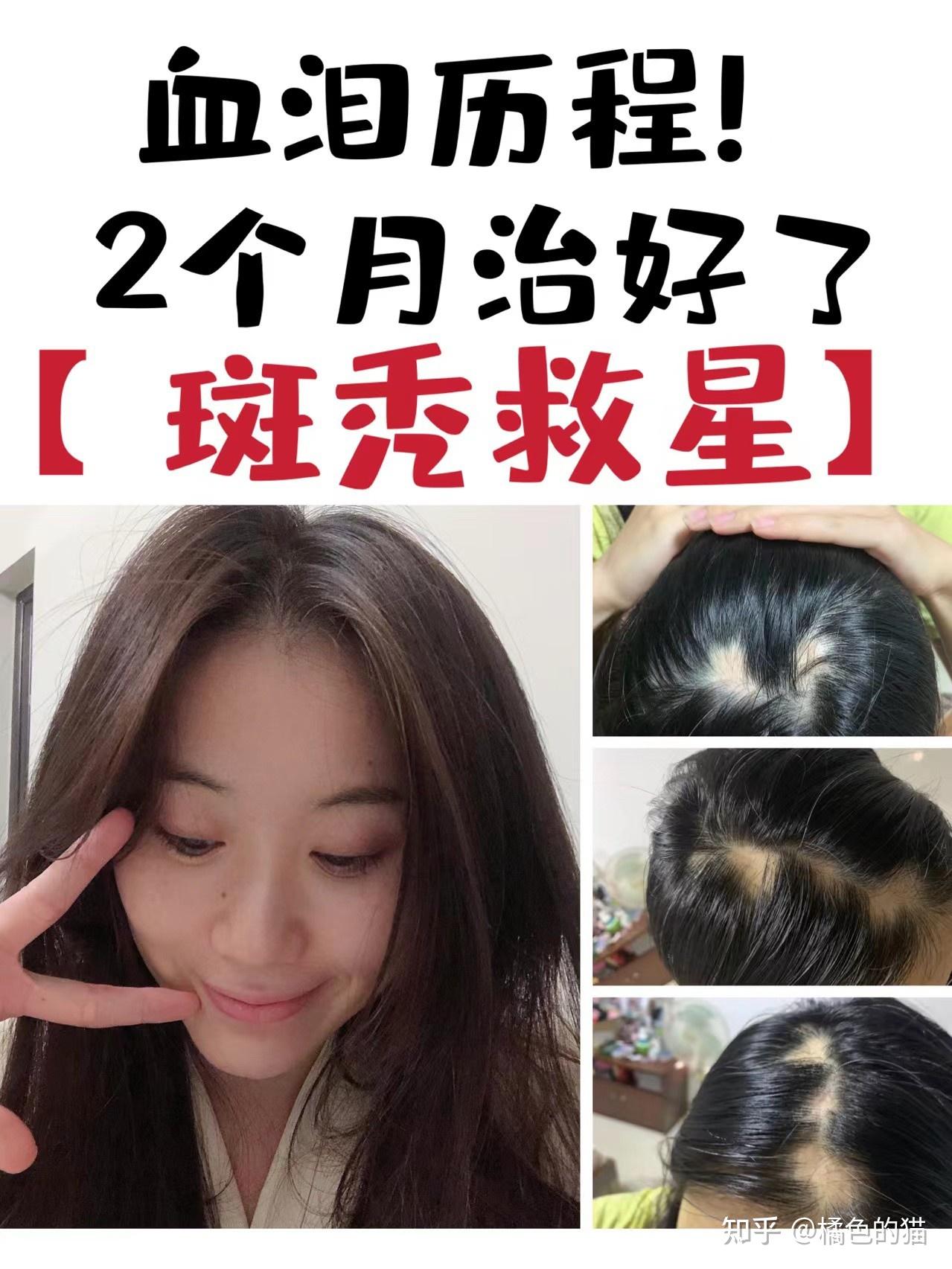 斑秃是个什么情况造成的,可以治好吗?