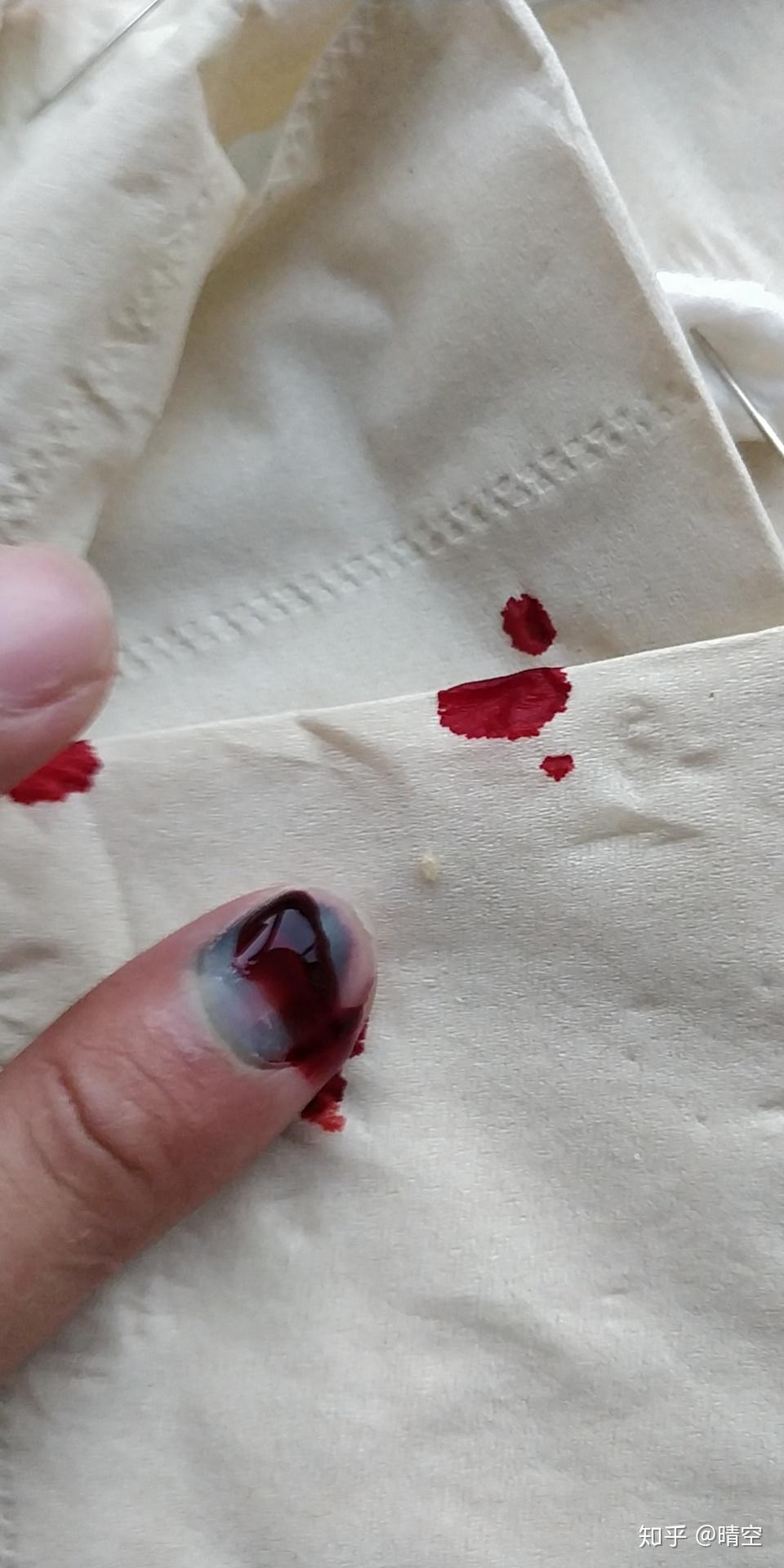 手指被门夹了,然后指甲里面四分之一有淤血,都两个月了还没好,怎么办?