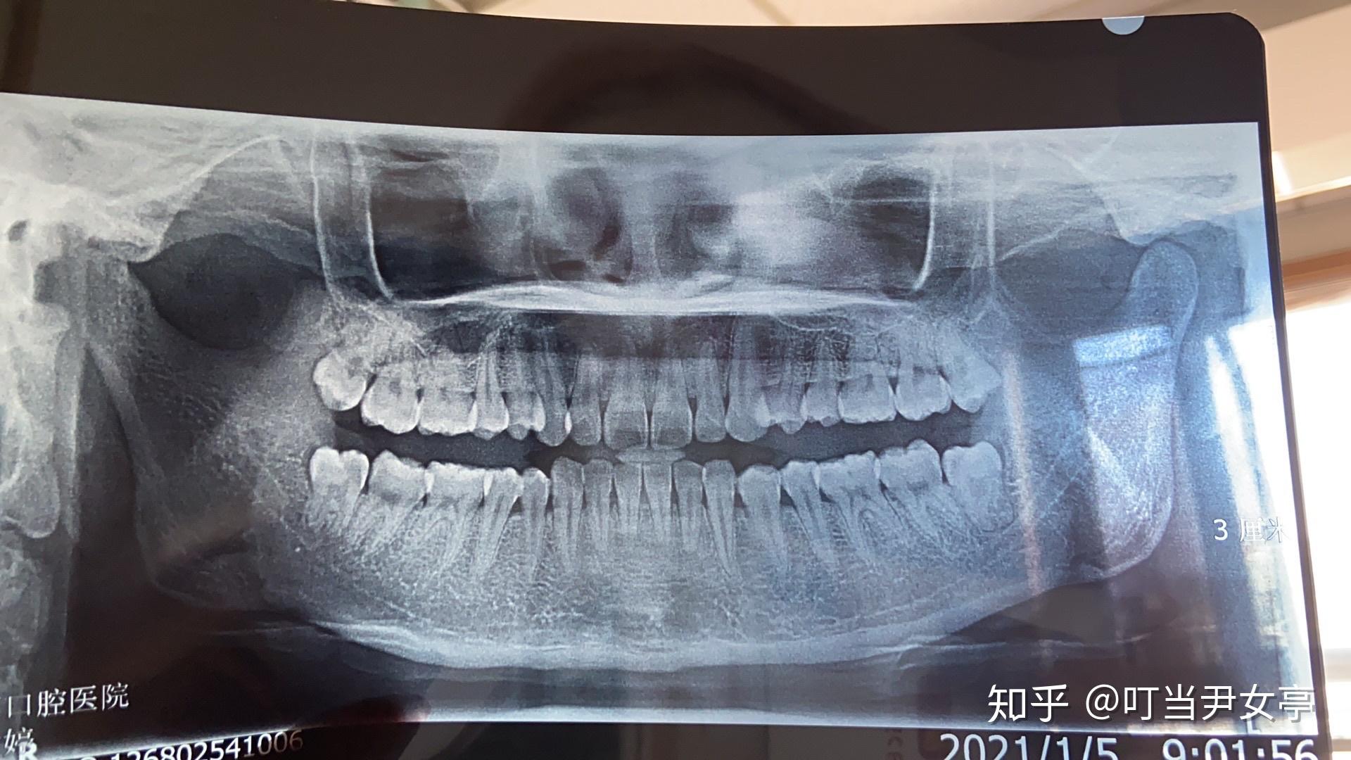拍智齿ct多少钱? - 知乎
