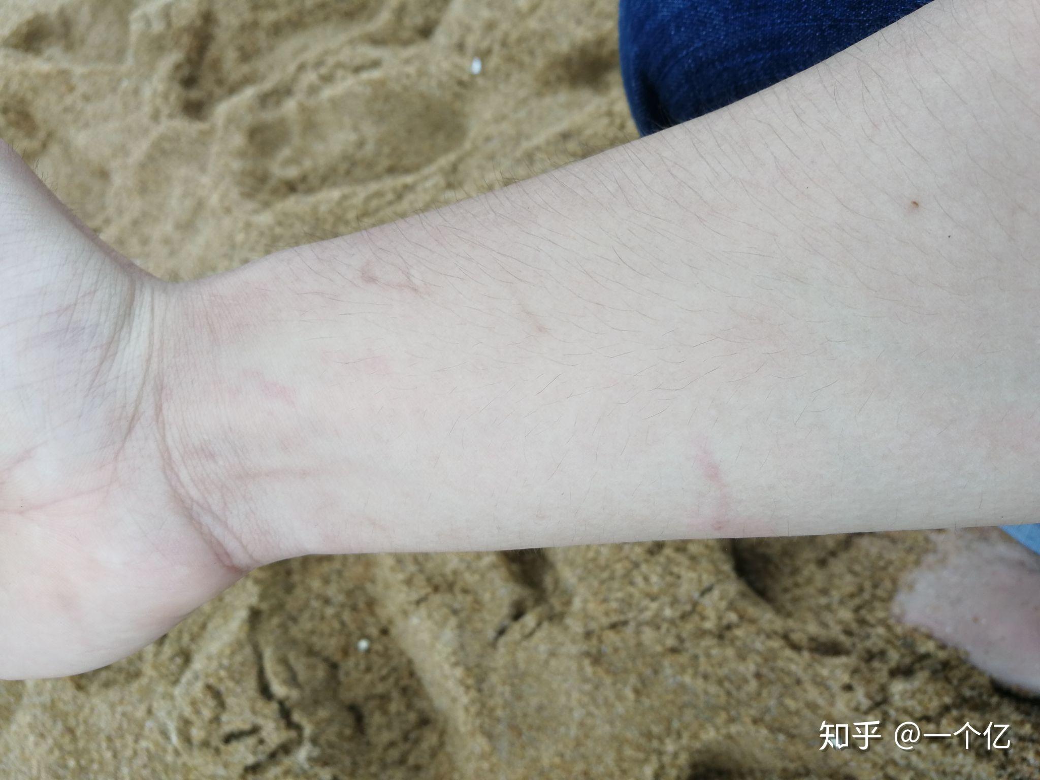 扎破僧帽水母的僧帽会怎样?