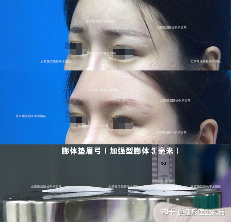 假体垫眉弓同时可以做提眉手术么?上睑松弛紧致术可联合丰眉弓 - 知乎