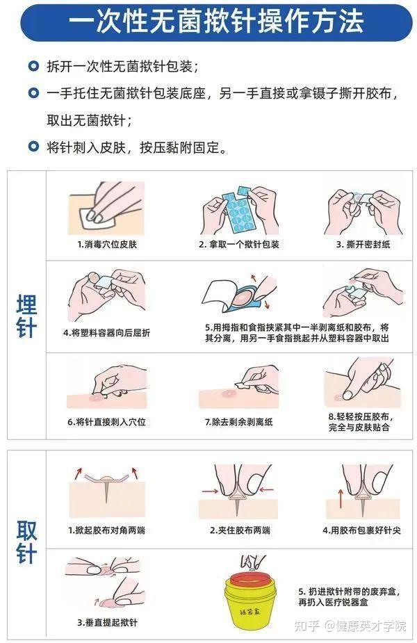 用之毫厘,功效千里:中医神奇的皮内针! - 知乎