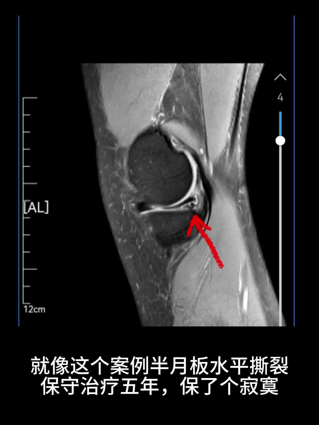 内侧半月板水平撕裂有可能恶化成桶柄样撕裂