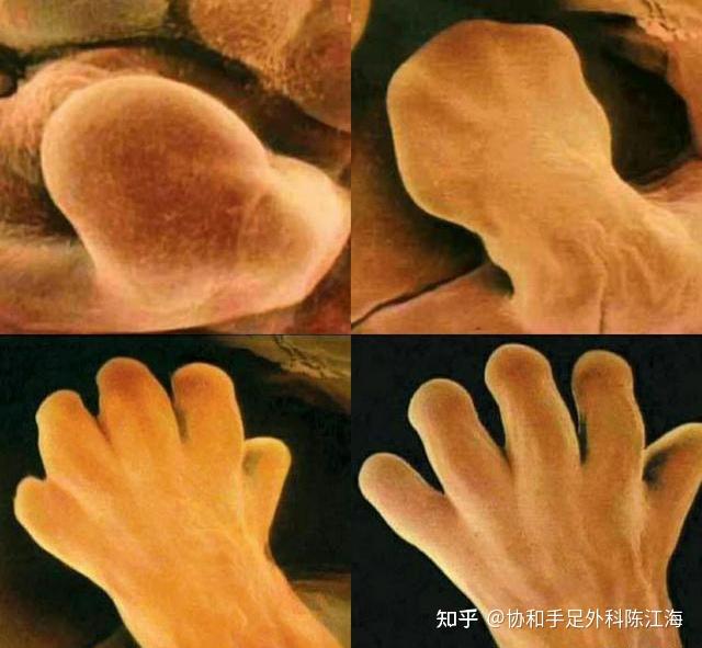 家族中没有出现过先天六指畸形,为何我会是六指?如果以后生育,会不会遗传给下一代? - 知乎