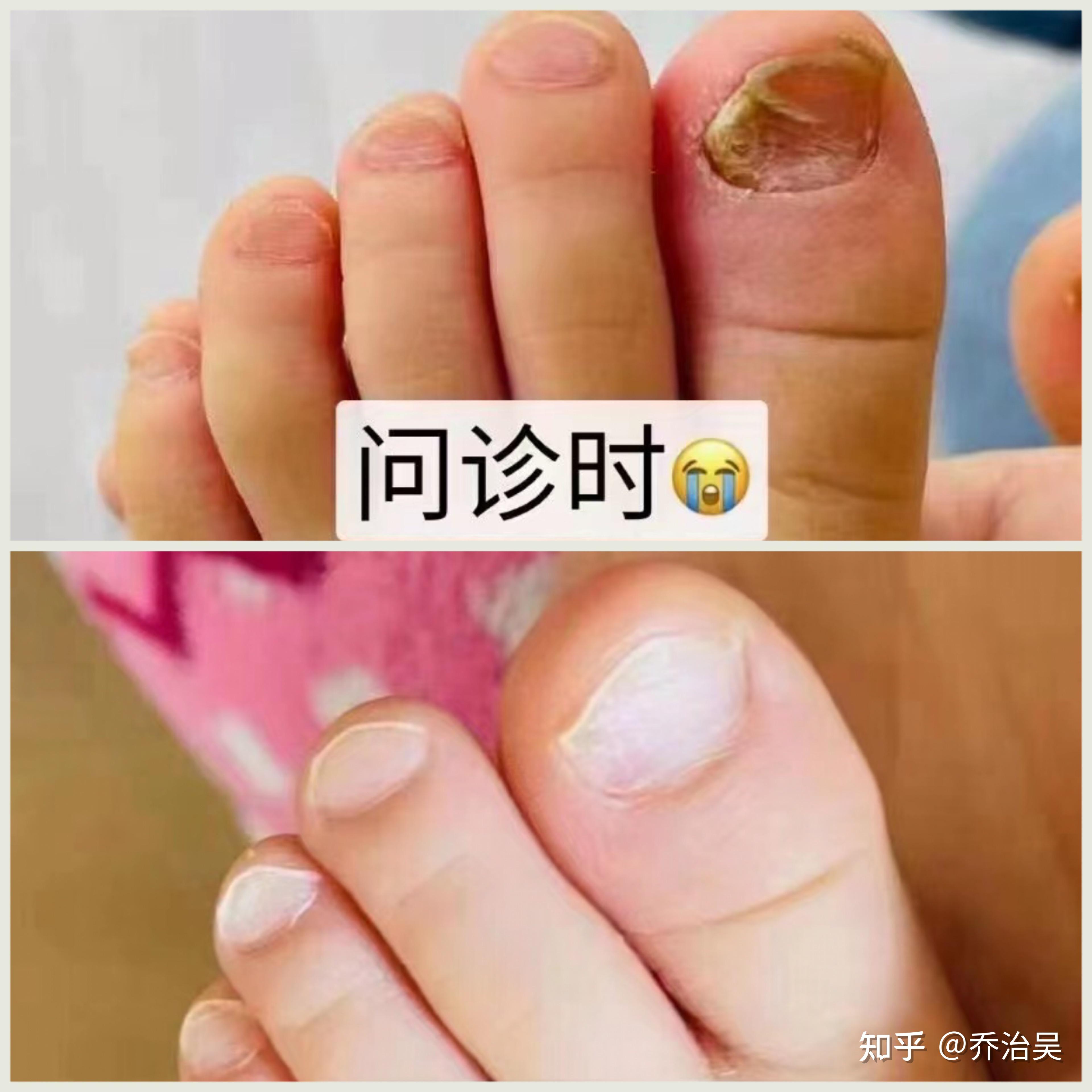 請問我家孩子的腳指甲是灰指甲麼