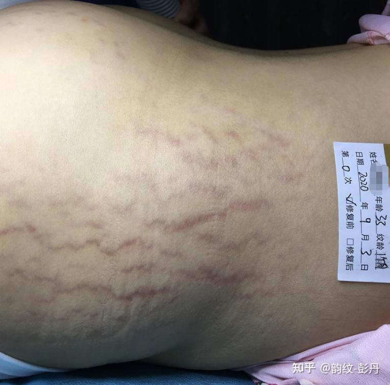 怎么才能去掉妊娠纹