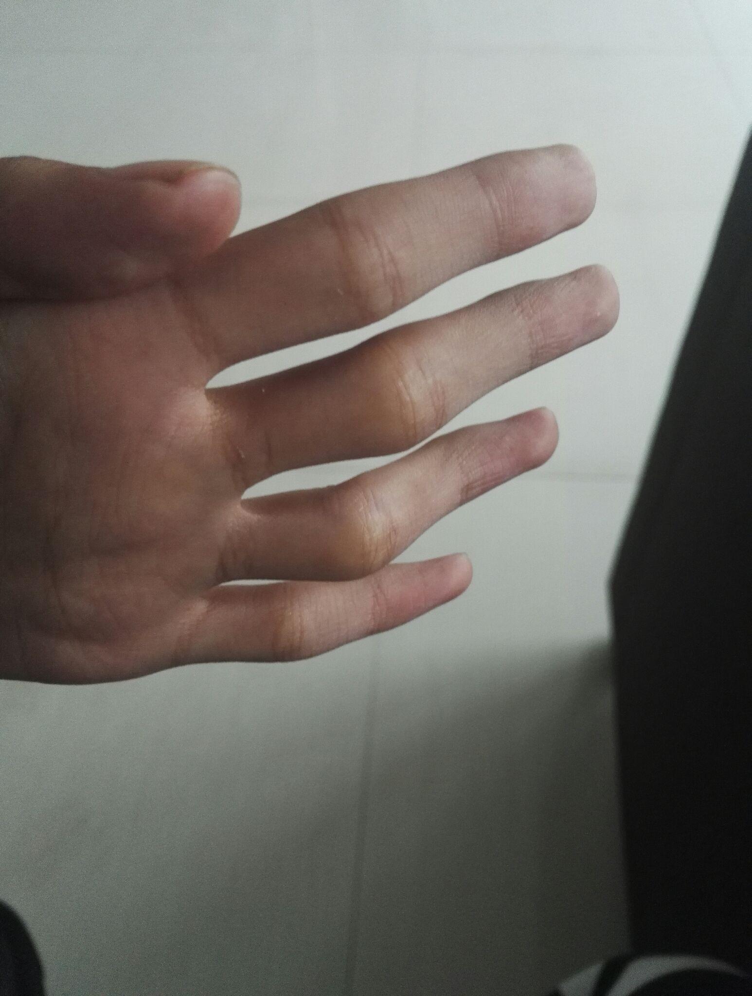 为什么我的手指伸不直