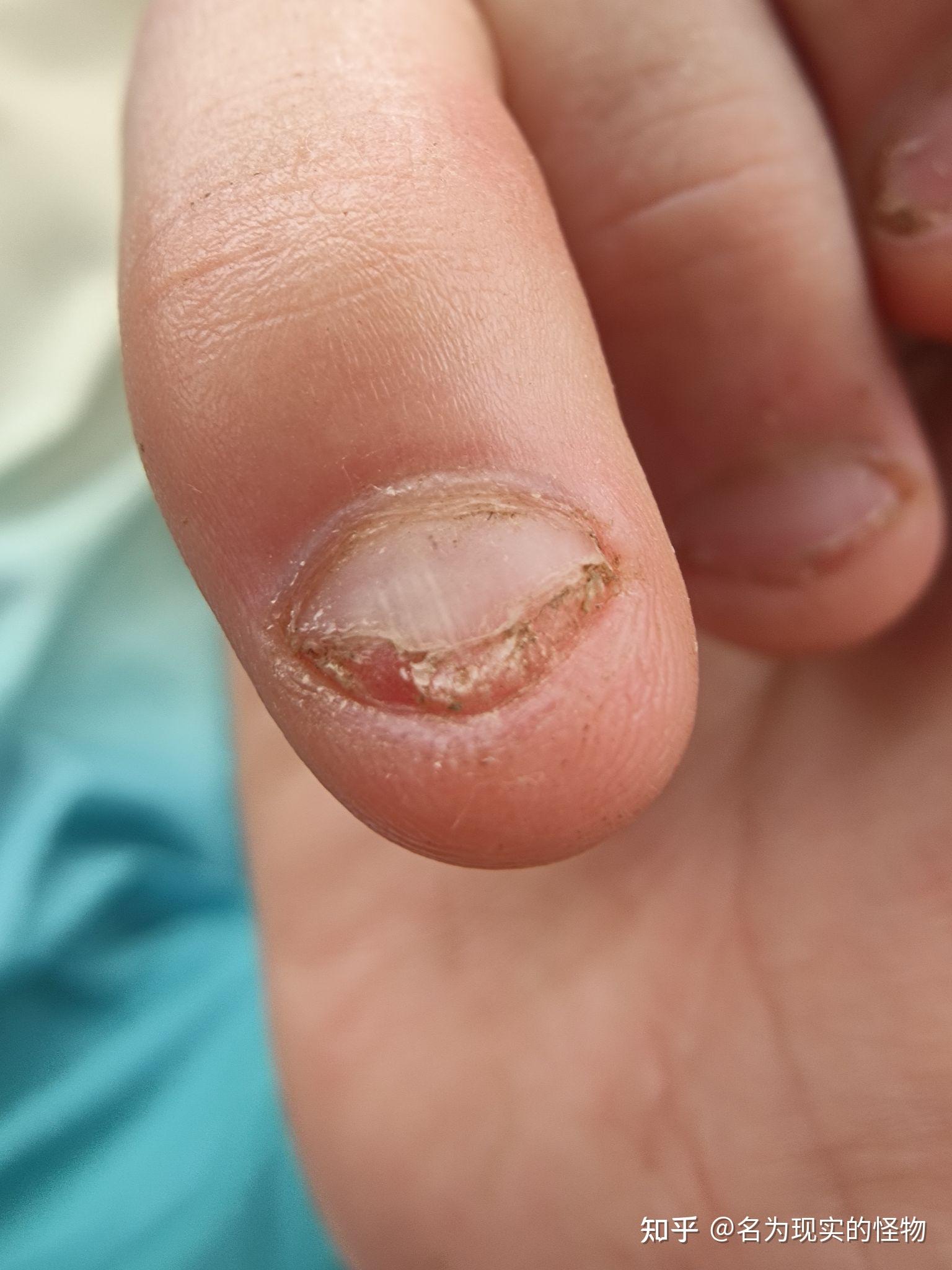 手指甲被咬的很短,甲床都没有了还能恢复吗? - 知乎