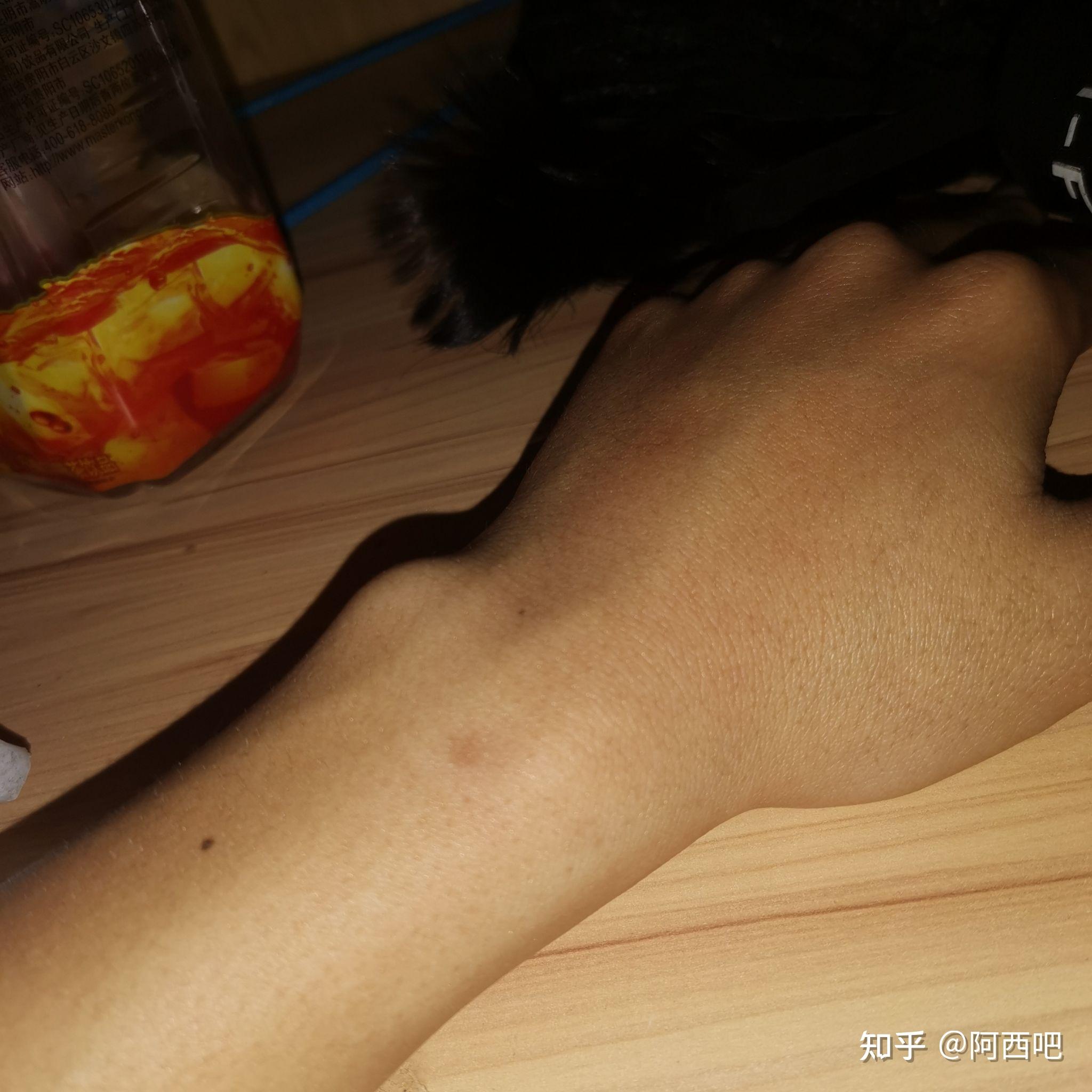 怎么样才能让手腕长肉呢细的都有点吓人了